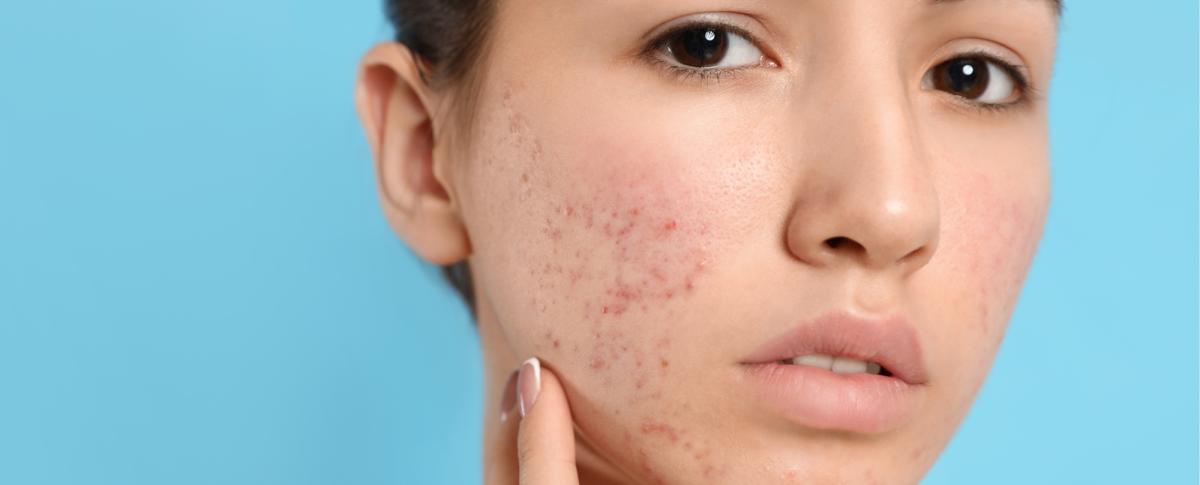 what gets rid of red post acne marks